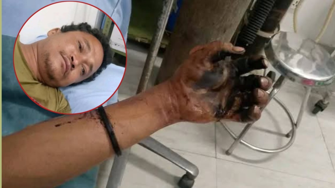 इकुडोलमा करेन्ट लागेर एकजना गम्भीर घाइते, वर्न अस्पतालको आईसीयूमा उपचार