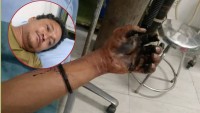 इकुडोलमा करेन्ट लागेर एकजना गम्भीर घाइते, वर्न अस्पतालको आईसीयूमा उपचार
